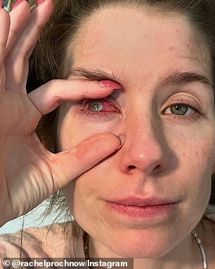 Actinic keratosis is estimated to affect about 1,500 Americans a year, making it a rare condition. Still, Ms. Prochnow said she wants to raise awareness about the issue because she was never told not to swim or shower with her contact lenses in.