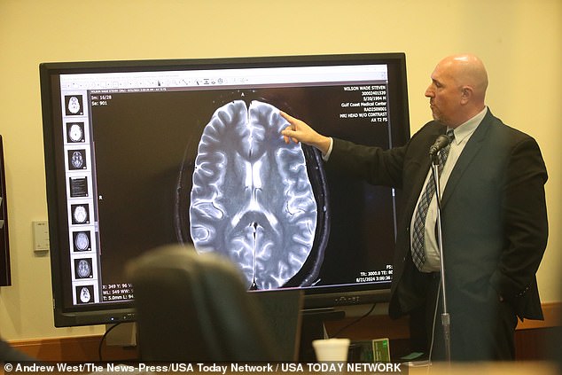 Dr. Thomas Coyne, a neuropathologist and associate medical examiner, testified in court Tuesday that he found no damage to Wilson's skull or brain.