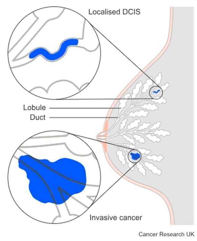 The graphic above shows the difference between ductal carcinoma in situ (DCIS) and invasive breast cancer.