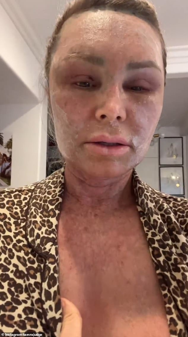 On Sunday, she shared an update on the third day of her recovery, with her face looking much more swollen and her skin peeling.