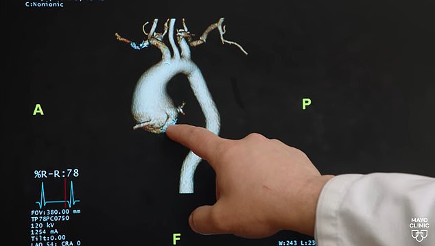 And this scan shows the swollen area that indicated he had an aortic aneurysm.