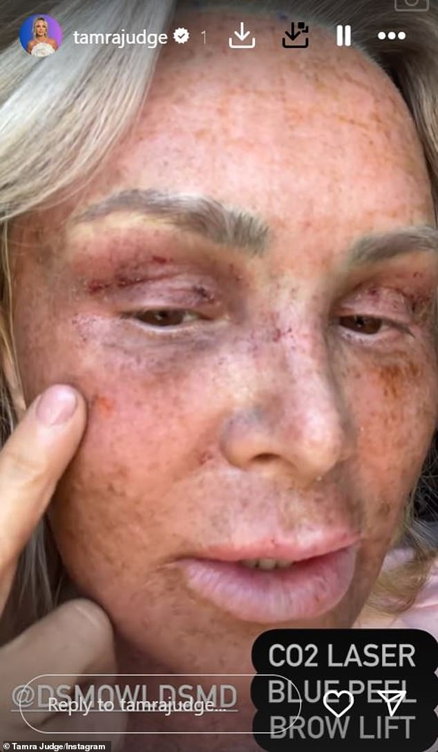 The Real Housewives of Orange County personality is recovering from multiple cosmetic surgeries, including a brow lift, a CO2 laser, and a blue peel.