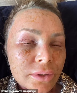 Tamra looks unrecognizable after undergoing a brow lift, CO2 laser, and blue chemical peel procedure.