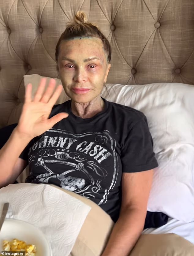 The reality star, who spent a lot of money on the surgical makeover as a 57th birthday present to herself, has spent days recovering in bed from the procedures.