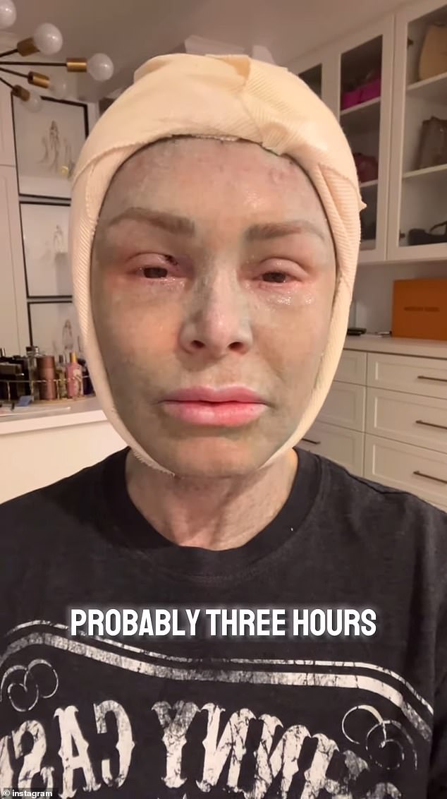 The Bravo star first shared video of her procedures on Saturday by sharing a photo of her bandaged head.