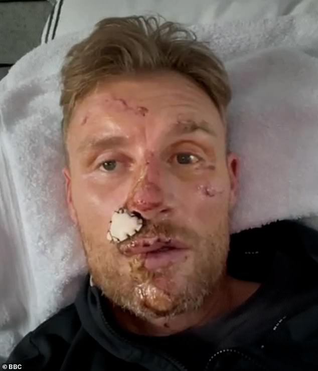 Photos reveal injuries suffered by Freddie Flintoff in an accident while filming Top Gear in December 2022