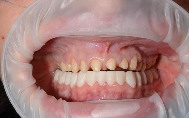 A Sydney dentist who came to the woman's aid said the Turkish clinic had removed a shocking amount of natural tooth structure, which he described as a 