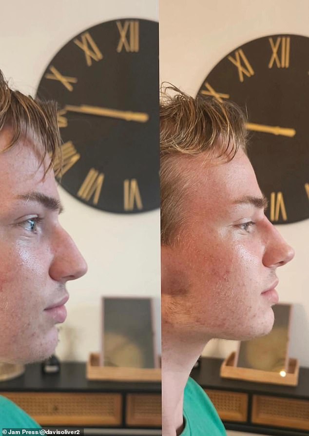 Liquid rhinoplasties have become extremely popular in recent years, and there are clinics across the country that offer walk-in rhinoplasties that are completed within an hour.