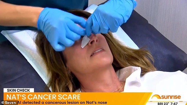 Nat Barr's routine skin check discovered skin cancer on her nose, and she spoke about it on Sunrise at the time.