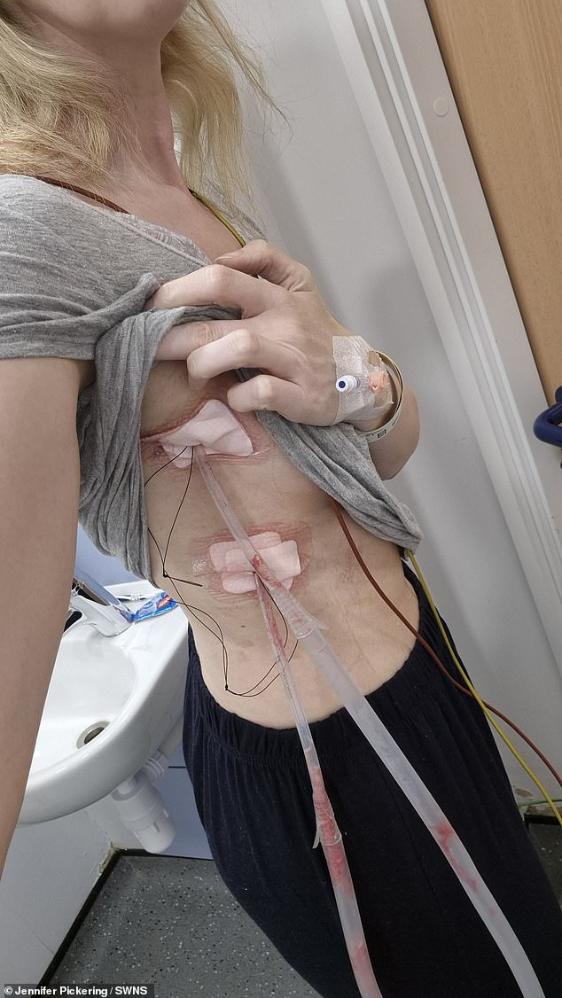 Ms Pickering began to think her lung collapses might be related to her menstrual cycle, but doctors ruled this out at first as she had not been diagnosed with pelvic endometriosis.