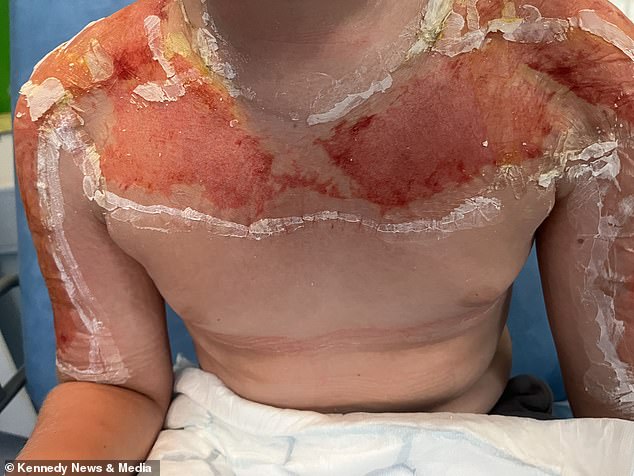 After calling NHS 111 for help, he was eventually admitted to Queen's Medical Centre in Nottingham, where he was treated for sunburn and underwent surgery to burst and clean his blisters.