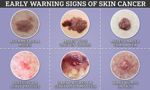 Signs of skin cancer range from harmless to obvious, but experts warn that treating cases early is key to making sure they don't spread or develop further.