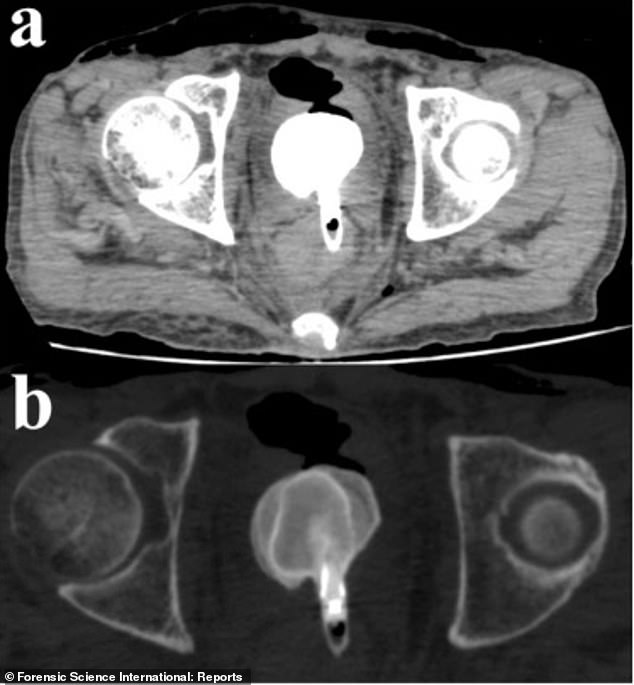 The CT scan above shows the eyeliner near the patient's bladder. The eyeliner tube was attached to a bladder stone, which likely formed from sediment and bacteria found in the tube.