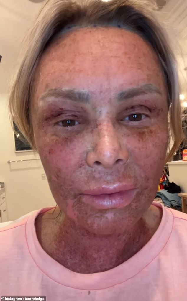 Celebrities like Real Housewives of Orange County star Tamra Judge (pictured) are turning to extreme laser treatments to achieve younger-looking skin.