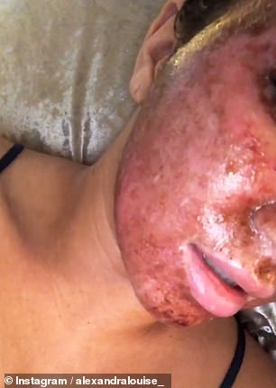 The reality star shows off her laser-treated skin just days after the procedure.