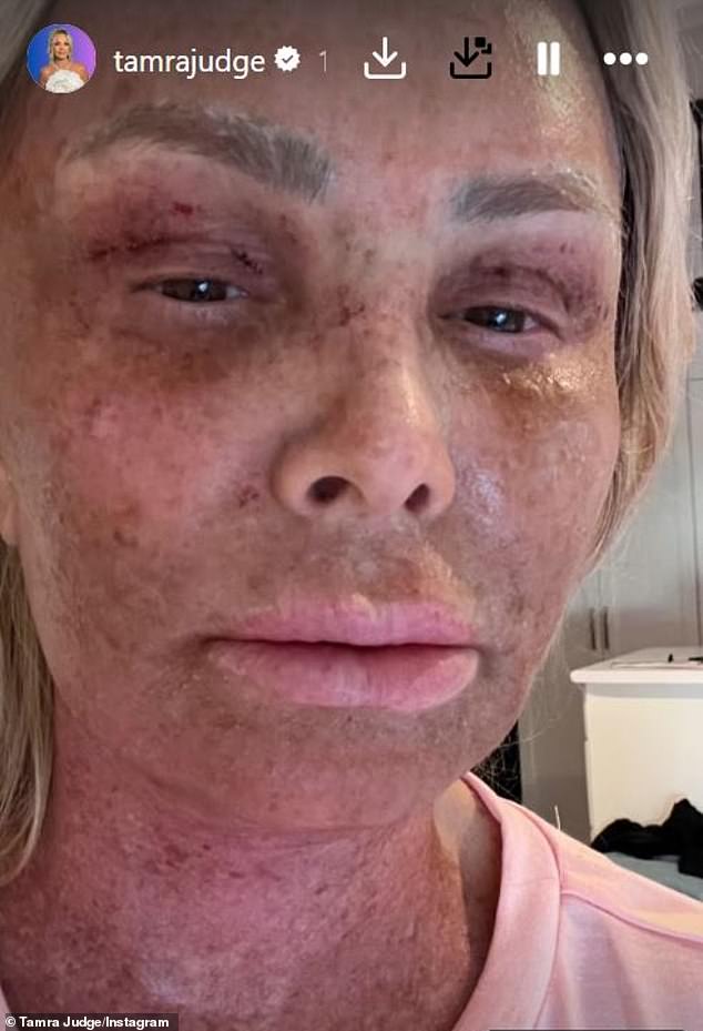 Real Housewives of Orange County star Tamra vowed to stop going under the knife after an eyebrow lift 