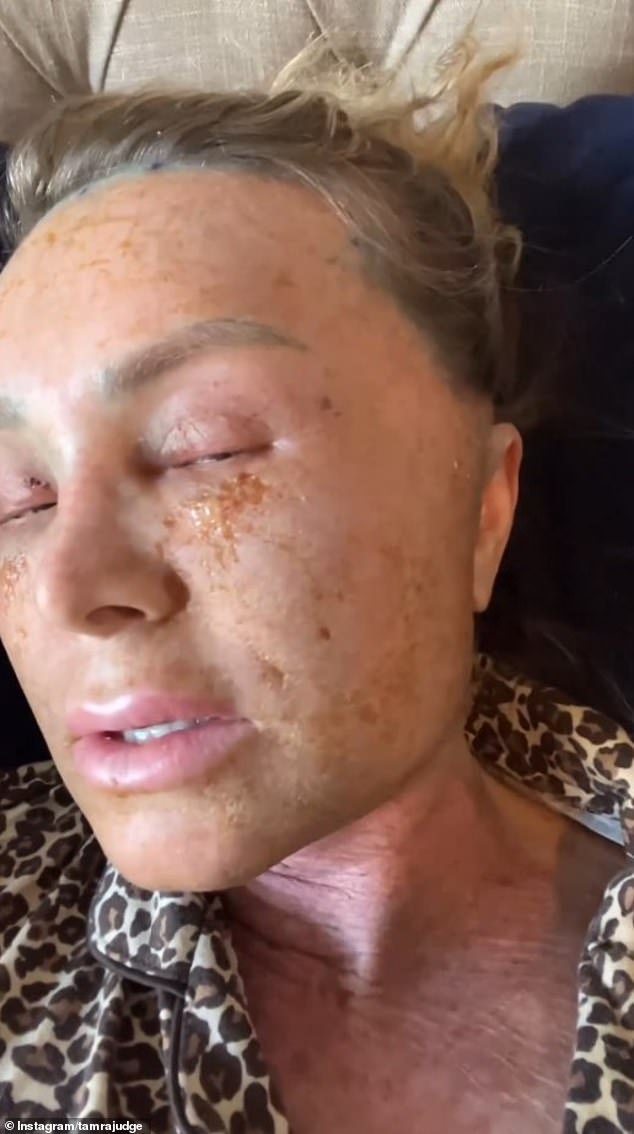 On Sunday, she shared an update on the third day of recovery, with her face looking much more swollen and her skin peeling, as she told her followers that she felt like her skin 