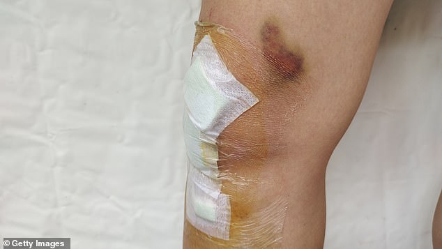 Around 3.8 million patients a year receive treatment for wounds on the NHS (file image)