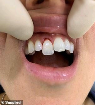 Cassandra will have to shell out $6,000 in dental bills to get her teeth fixed