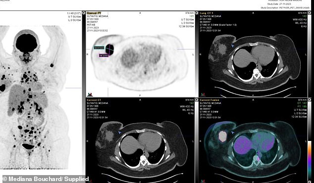 The X-ray shows that the cancer had spread beyond the breast to other organs in the body.