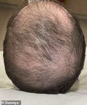 A 32-year-old client before micrografting