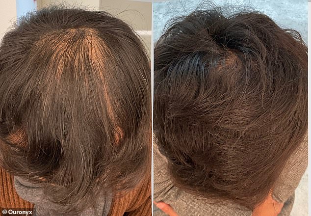 A 51-year-old man, who is a CEO, considered having a hair transplant but decided against it due to his busy schedule and instead tried micrografting. Pictured here, from top to bottom: before treatment and six months after.