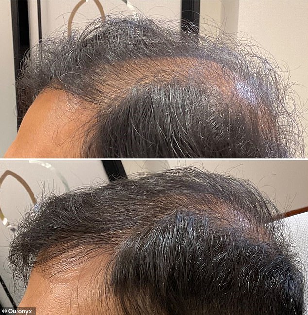 Micrografting also helped a 29-year-old man with his hair loss, which had started at a relatively young age. Pictured, from top to bottom: before treatment and six months after