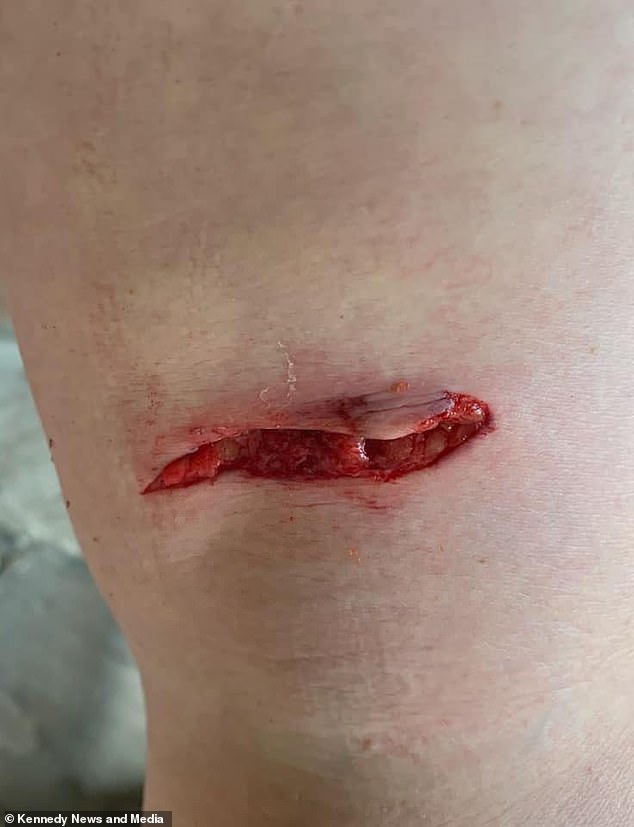 It was only when her husband, David, took a photo of the wound to show her what looked like a 7cm gash just above the back of her right knee that she realised the extent of her injury.