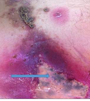 A 55-year-old man presented to the hospital with a severe case of a flesh-eating bacterial infection that had caused a large sore on his torso.