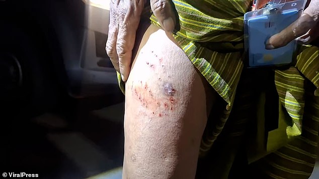 He had wounds on his leg from the python bite (pictured)