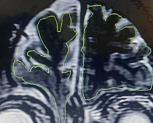 The image above shows the encephalocele that has passed through the patient's skull into his nasal cavity.