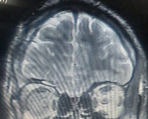 The image above shows the patient's brain after the encephalocele was removed.