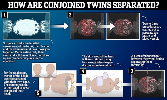 1726731527 864 British surgeons successfully separate conjoined twins in radical 14 hour operation