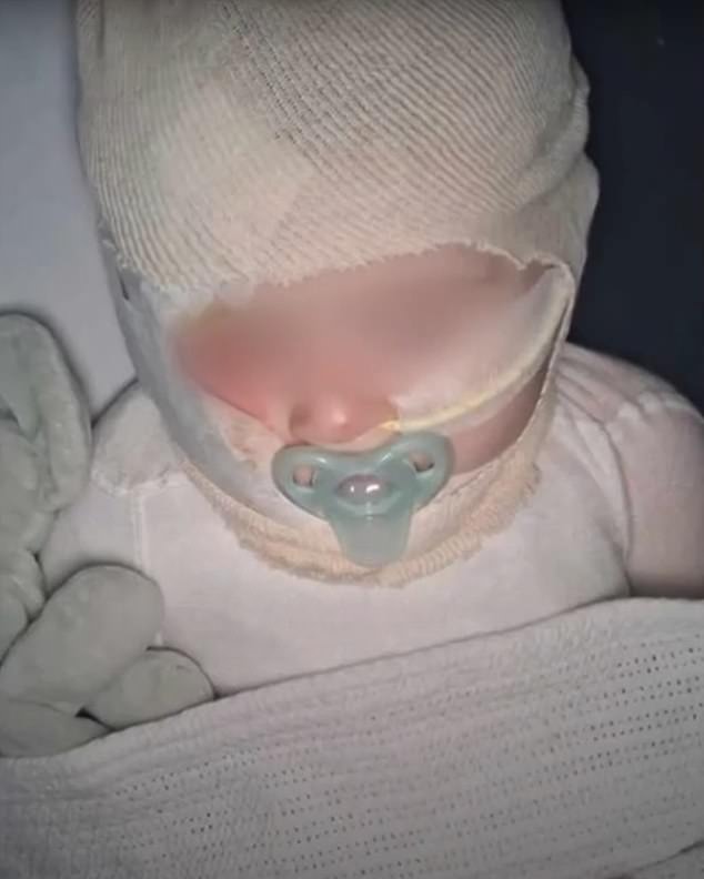 The nine-month-old baby (pictured) suffered severe burns to his face, upper body and arms and has undergone seven operations at Queensland Children's Hospital.