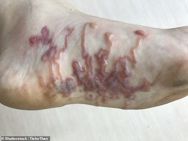 A separate case of the subcutaneous black substance. The lines form when the body's immune system reacts to the worms inside, causing inflammation and itching, which appear as these raised lines on the surface of the skin.