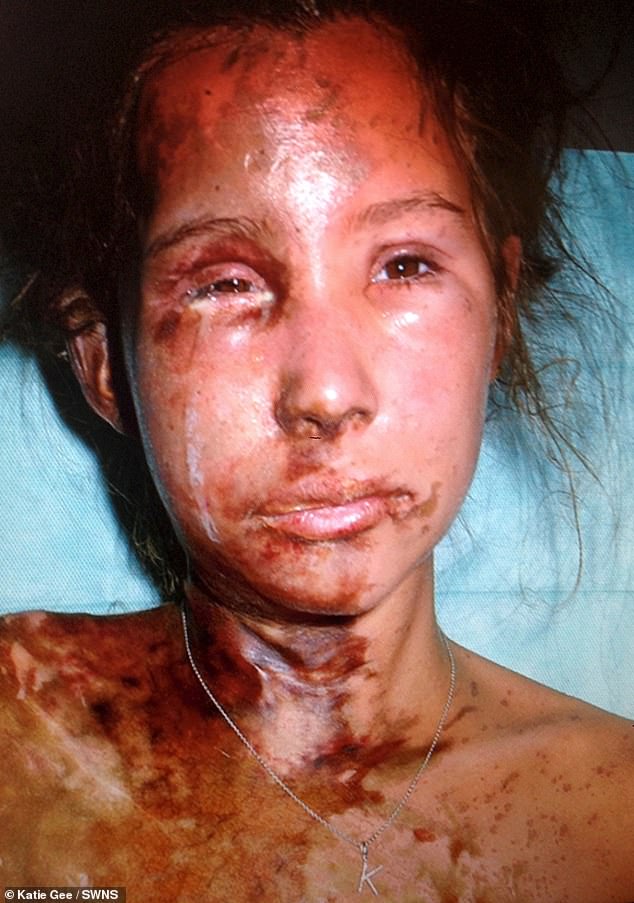 Katie suffered severe burns and had to undergo 70 operations over three years to recover from the attack.