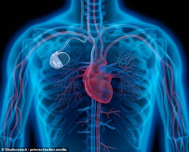 Traditional pacemakers use wires and a generator under the skin to keep the heart beating regularly. (File photo)