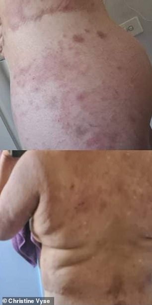 His body was covered with severe eczema.