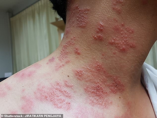 Shingles is a viral infection caused by the same virus responsible for chickenpox. Sufferers experience rashes or blisters that are painful and may itch (file image)