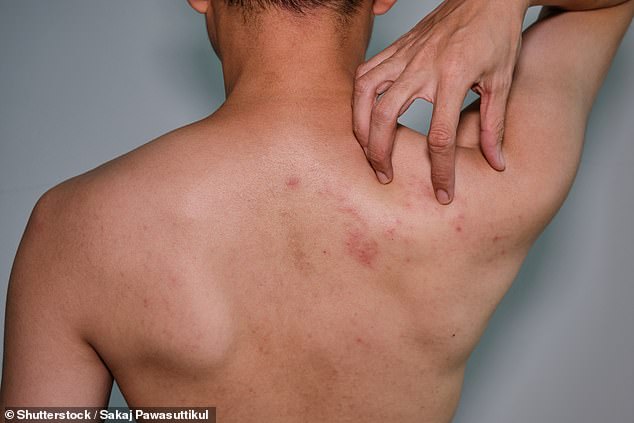 Expansion to include younger and immunocompromised patients in the National Immunization Program for the shingles vaccine will help people save up to $560 (stock image of a shingles rash on a man's back)