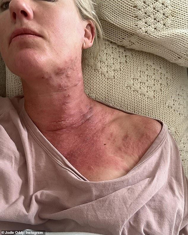 Jodie Oddy, co-host of Adelaide's Nova 919 breakfast show with Andrew Hayes, has spoken out about her recent hellish holiday which saw her contract a case of shingles.