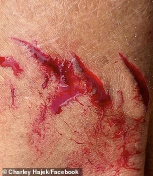 A bull shark bit a professional surfer's left leg