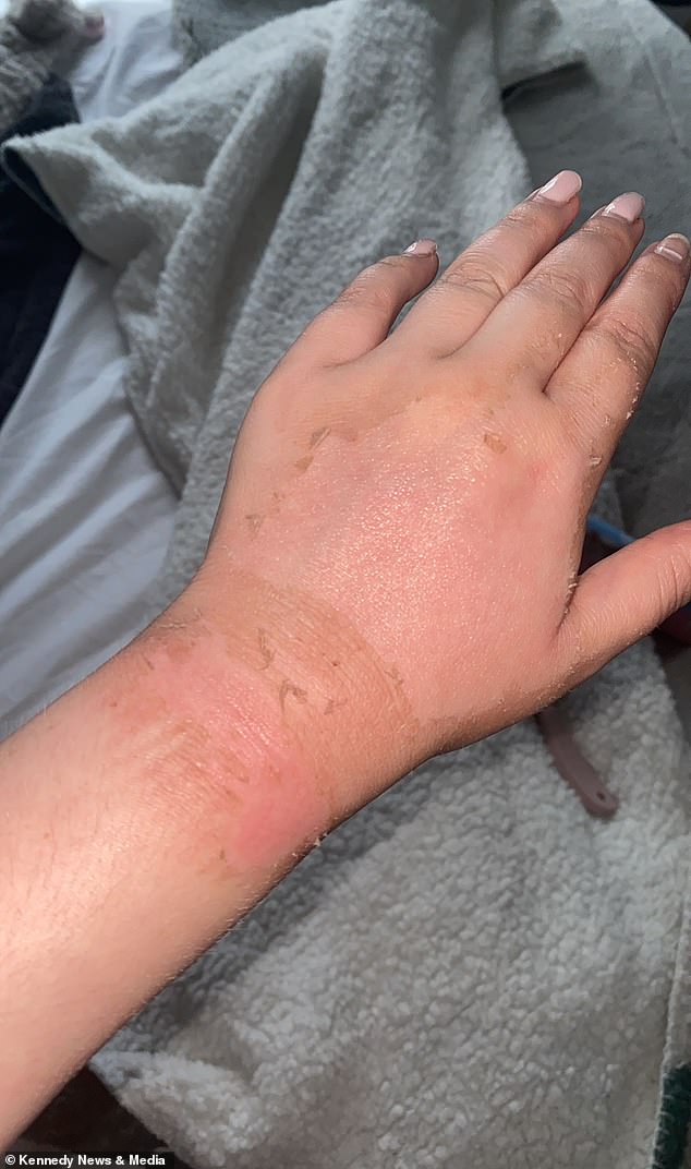 Experts recommend throwing away a hot water bottle after two years, as the rubber degrades and is likely to break. Pictured: The dead, scaly skin on Ms. Hardy's hands.