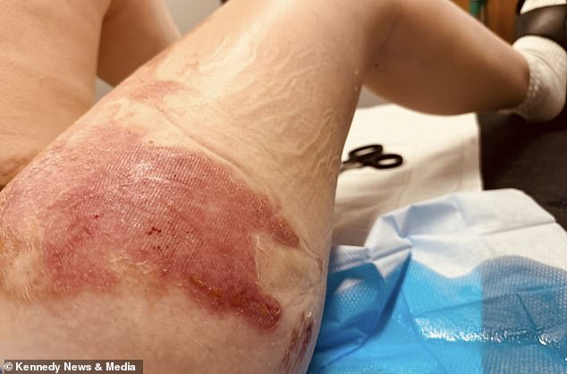 Doctors say Hardy could be scarred for life as a result of this ordeal.