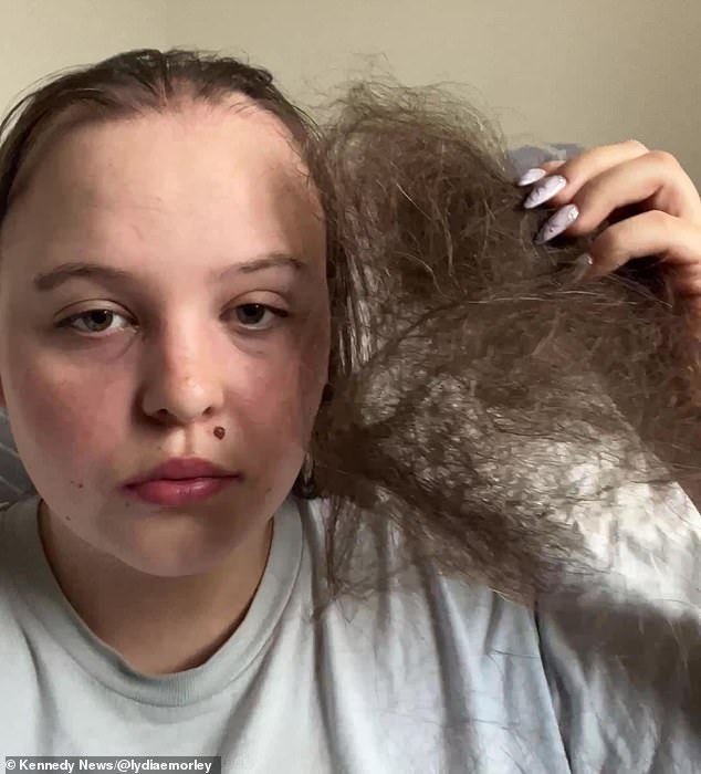 Within five months of being diagnosed with alopecia, Lydia lost 80 percent of her hair.