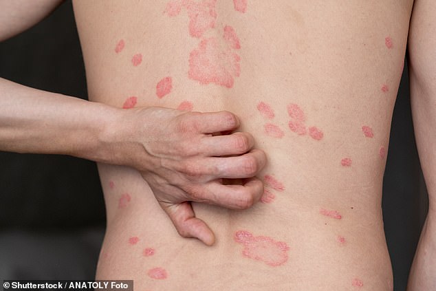 Psoriasis leaves sufferers covered in disfiguring red, scaly patches and affects one in 50 people in the UK.