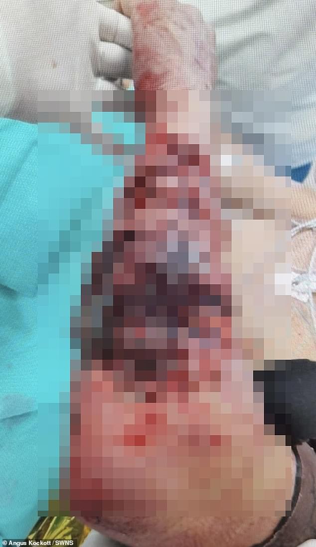 A blurred image shows Angus' shark bite after the attack, which he says left his arm 