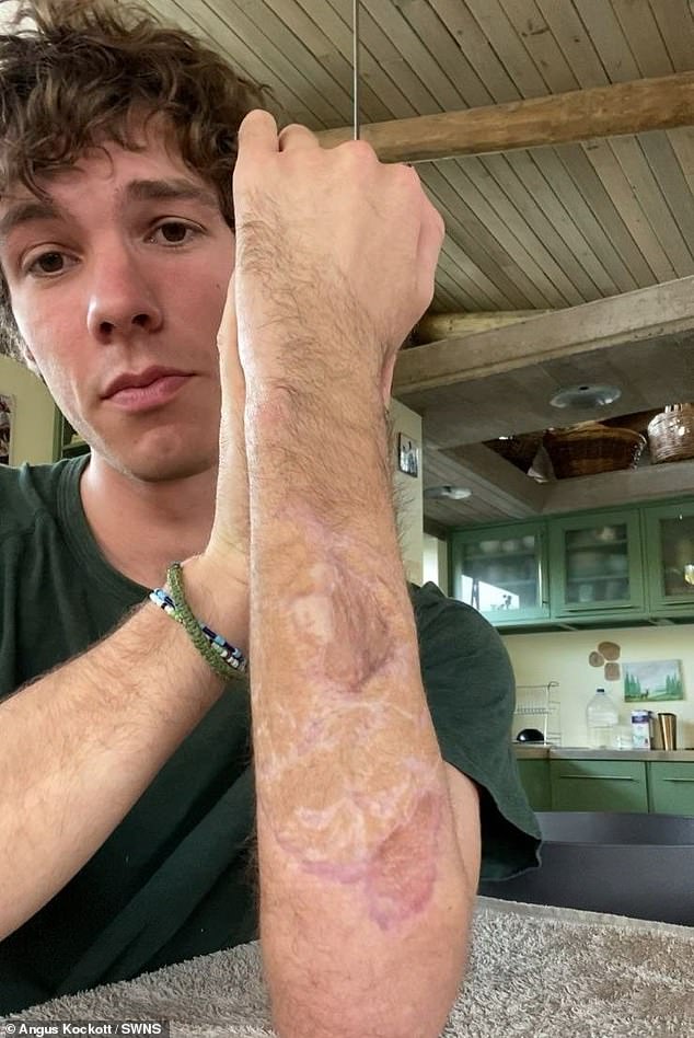 Angus shows how his arm was able to heal after the attacks, thanks to a skin graft he received, using skin from his left thigh, and a nerve graft using nerves transplanted from the back of his heel.