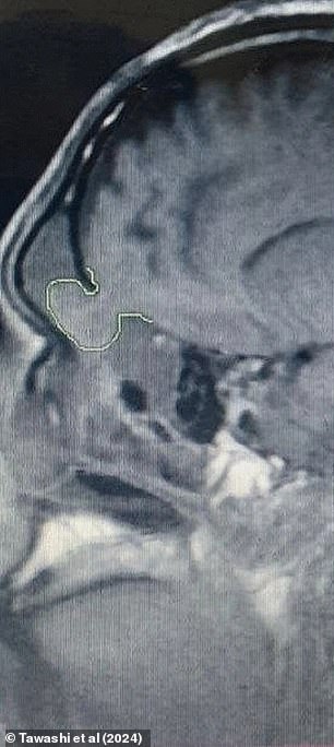 The image above shows the man's encephalocele in his nasal cavity.