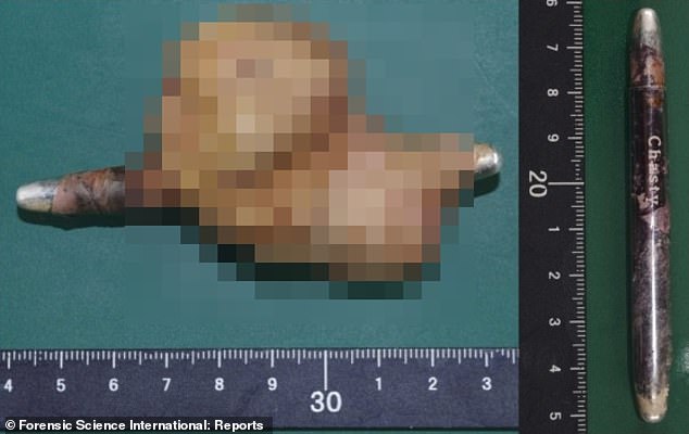 The above image from the patient's autopsy shows the eyeliner tube penetrating a large bladder stone, which likely formed as a result of the eyeliner penetrating and damaging the bladder.